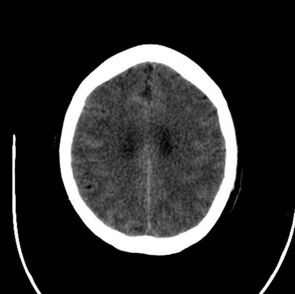 File:Cerebellar hemorrhage causing obstructive hydrocephalus (Radiopaedia 33989-35207 Axial non-contrast 37).jpg