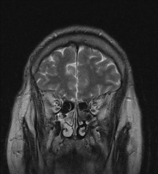 File:Cerebellopontine angle meningioma (Radiopaedia 24459-24764 Coronal T2 3).jpg