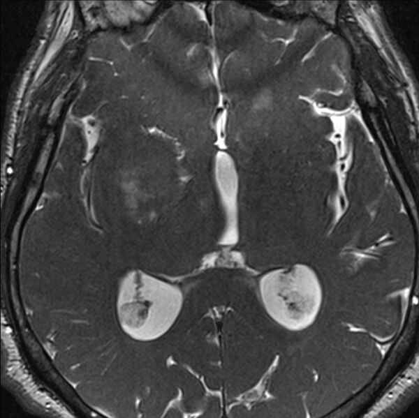 File:Cerebellopontine angle meningioma (Radiopaedia 24459-24764 I 53).jpg