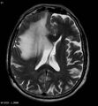 Cerebral abscesses secondary to contusions (Radiopaedia 5201-6968 Axial T2 2).jpg