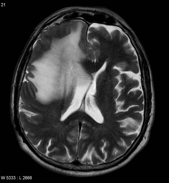 File:Cerebral abscesses secondary to contusions (Radiopaedia 5201-6968 Axial T2 2).jpg