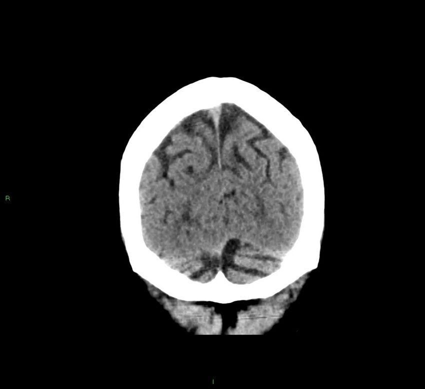 Cerebral amyloid angiopathy-associated lobar intracerebral hemorrhage (Radiopaedia 58376-65511 Coronal non-contrast 12).jpg