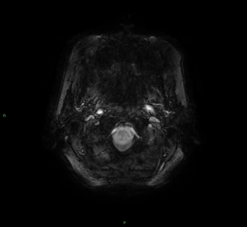 Cerebral amyloid angiopathy-associated lobar intracerebral hemorrhage (Radiopaedia 58378-65517 Axial SWI 4).jpg