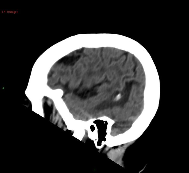 File:Cerebral amyloid angiopathy-associated lobar intracerebral hemorrhage (Radiopaedia 58378-65518 C 19).jpg