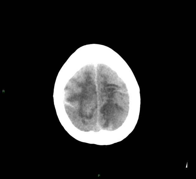 File:Cerebral amyloid angiopathy-associated lobar intracerebral hemorrhage (Radiopaedia 58529-65687 Axial non-contrast 9).jpg