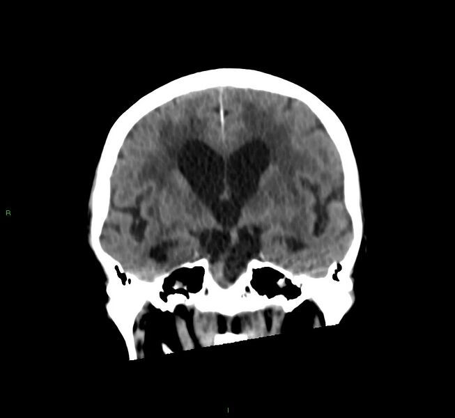 File:Cerebral amyloid angiopathy-associated lobar intracerebral hemorrhage (Radiopaedia 58530-65688 Coronal non-contrast 38).jpg