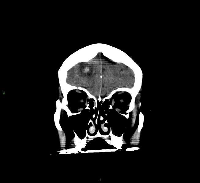 File:Cerebral amyloid angiopathy-associated lobar intracerebral hemorrhage (Radiopaedia 58560-65723 Coronal non-contrast 56).jpg