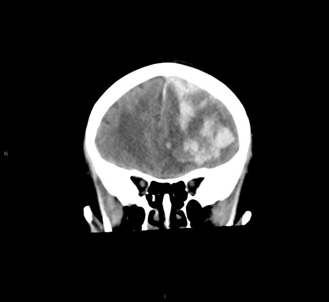 File:Cerebral amyloid angiopathy-associated lobar intracerebral hemorrhage (Radiopaedia 58561-65724 Coronal non-contrast 45).jpg
