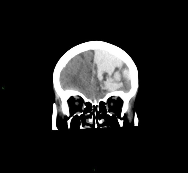File:Cerebral amyloid angiopathy-associated lobar intracerebral hemorrhage (Radiopaedia 58561-65724 Coronal non-contrast 49).jpg