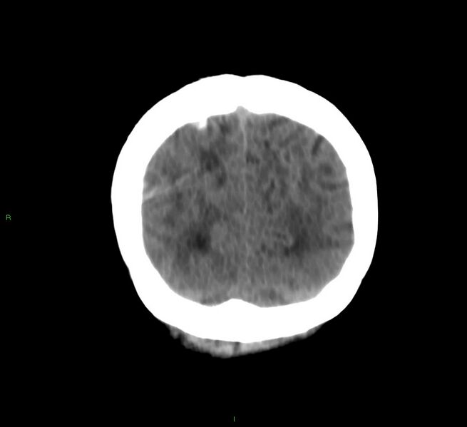 File:Cerebral amyloid angiopathy-associated lobar intracerebral hemorrhage (Radiopaedia 58566-65730 Coronal non-contrast 15).jpg