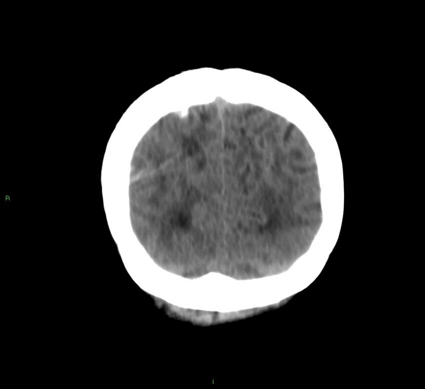 Cerebral amyloid angiopathy-associated lobar intracerebral hemorrhage (Radiopaedia 58566-65730 Coronal non-contrast 15).jpg