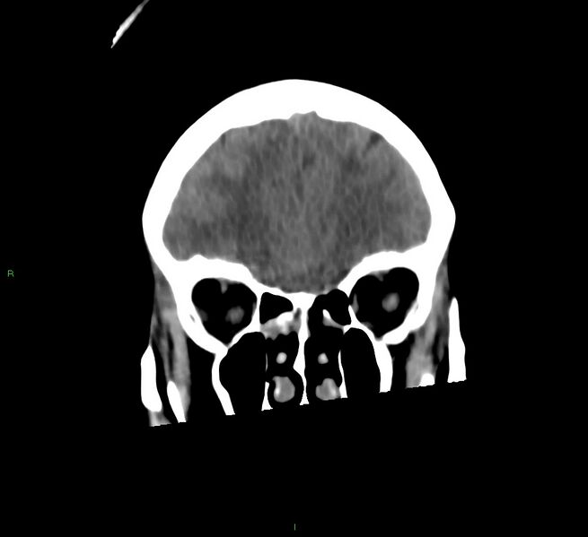 File:Cerebral amyloid angiopathy-associated lobar intracerebral hemorrhage (Radiopaedia 58566-65730 Coronal non-contrast 54).jpg