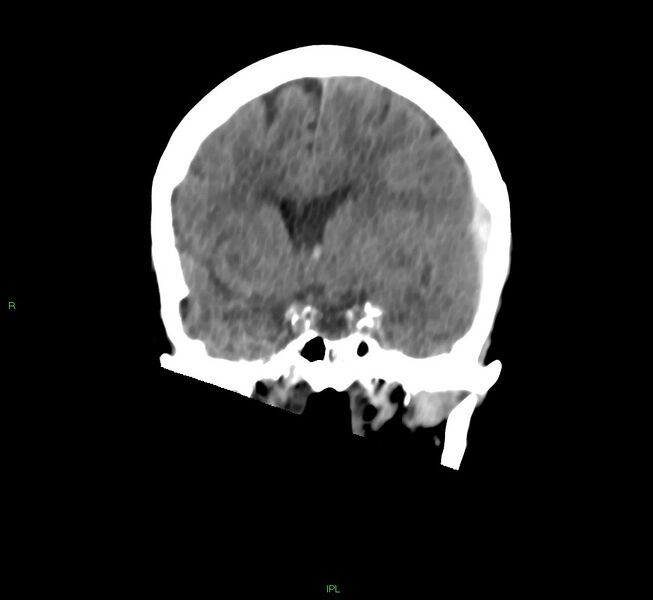 File:Cerebral amyloid angiopathy-associated lobar intracerebral hemorrhage (Radiopaedia 58754-65975 Coronal non-contrast 39).jpg