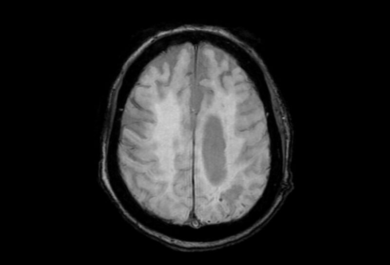 File:Cerebral amyloid angiopathy (Radiopaedia 86671-102792 Axial Gradient Echo 15).jpg