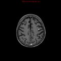 Cerebral and orbital tuberculomas (Radiopaedia 13308-13311 Axial T1 C+ 16).jpg