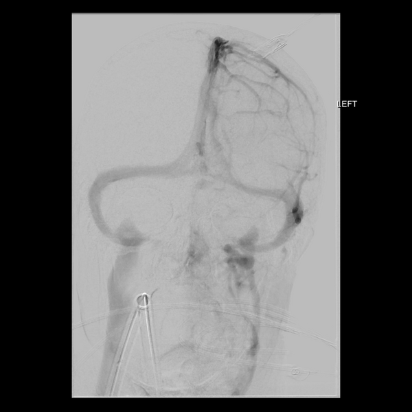 File:Cerebral arteriovenous malformation with lobar hemorrhage (Radiopaedia 44725-48513 LT CCA IC 22).png