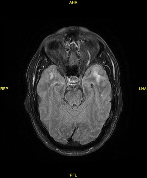 File:Cerebral autosomal dominant arteriopathy with subcortical infarcts and leukoencephalopathy (CADASIL) (Radiopaedia 86108-102054 Axial FLAIR 11).jpg