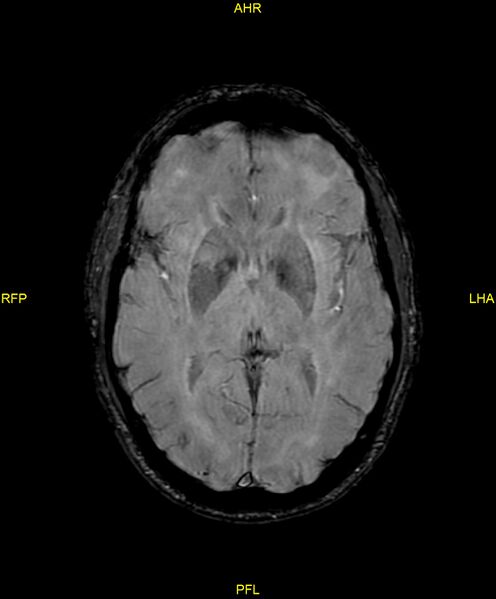 File:Cerebral autosomal dominant arteriopathy with subcortical infarcts and leukoencephalopathy (CADASIL) (Radiopaedia 86108-102054 Axial SWI 56).jpg