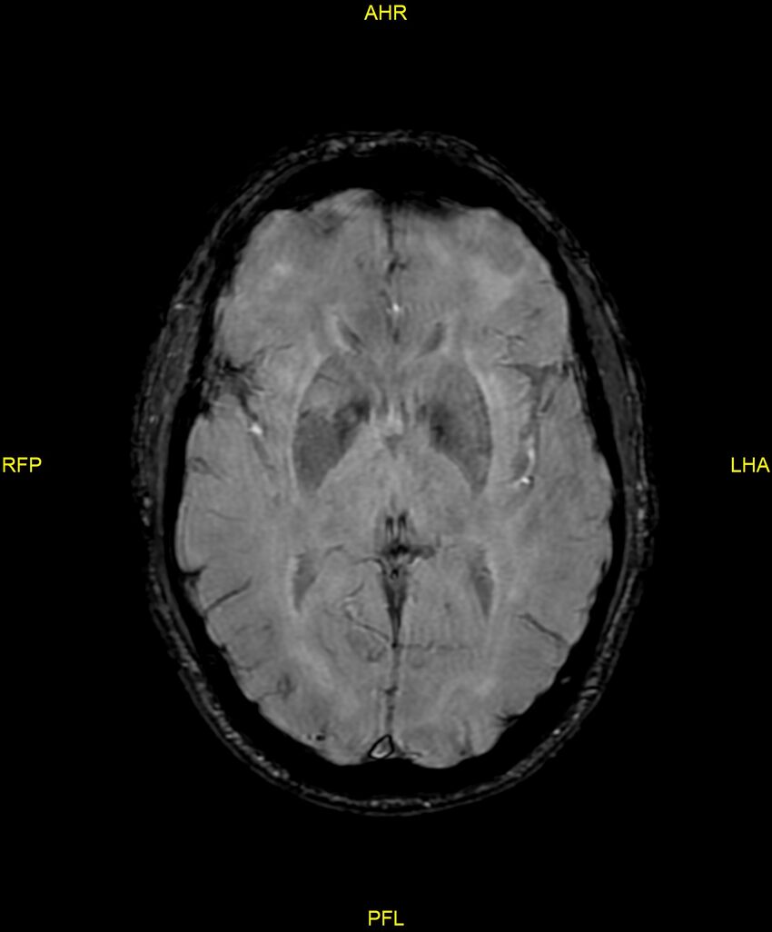 Cerebral autosomal dominant arteriopathy with subcortical infarcts and leukoencephalopathy (CADASIL) (Radiopaedia 86108-102054 Axial SWI 56).jpg