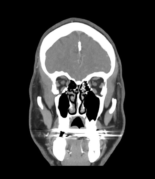 File:Cerebral dural venous sinus thrombosis (Radiopaedia 86514-102576 B 9).jpg