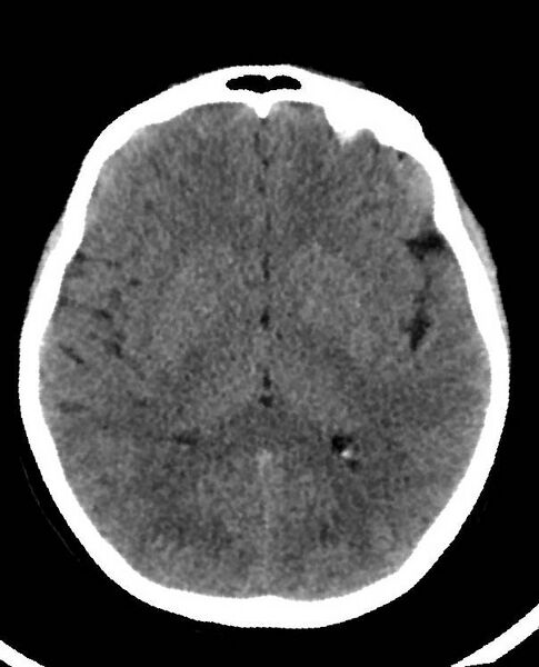 File:Cerebral edema due to severe hyponatremia (Radiopaedia 89826-106938 Axial non-contrast 53).jpg