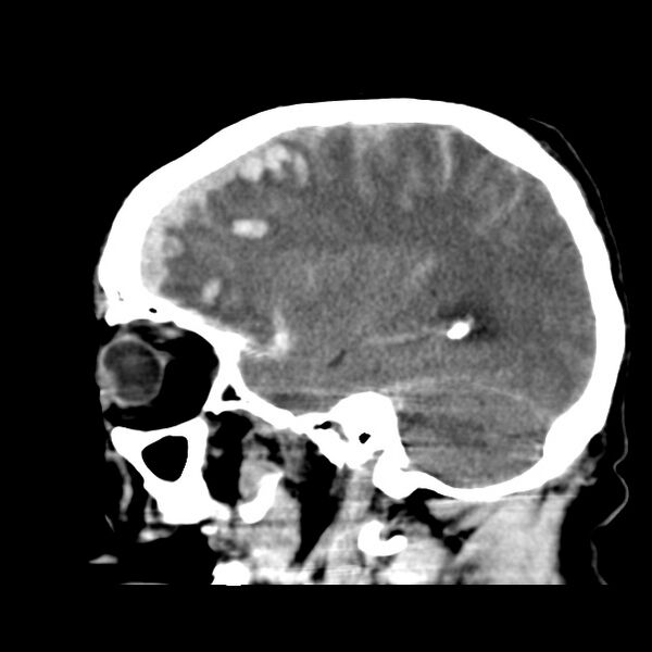 File:Cerebral hemorrhagic contusions (Radiopaedia 23145-23188 C 31).jpg