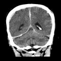 Cerebral hemorrhagic contusions (Radiopaedia 23145-23188 Coronal non-contrast 31).jpg