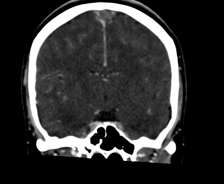File:Cerebral venous sinus thrombosis (Radiopaedia 59224-66646 Coronal C+ delayed 36).jpg