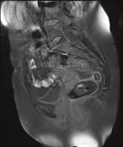 File:Cervical carcinoma (Radiopaedia 88312-104943 Sagittal T1 fat sat 15).jpg