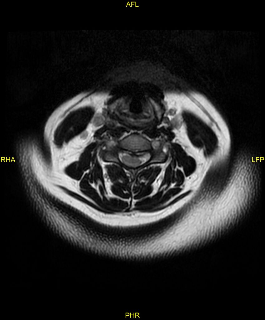 Cervical disc protrusion (Radiopaedia 87147-103415 Axial T2 16).jpg
