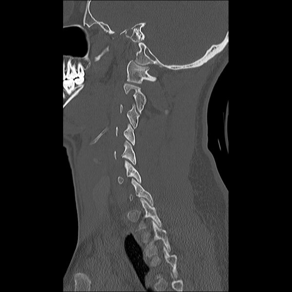 File:Cervical facet fracture and anterior discoligamentous injury (Radiopaedia 32139-33083 Sagittal bone window 9).jpg