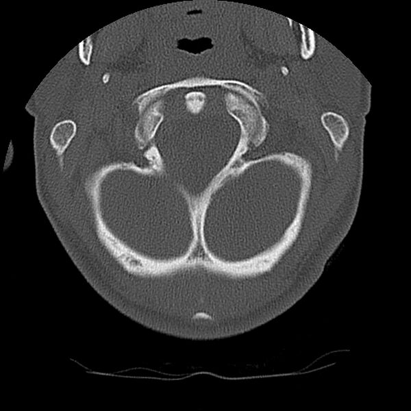 File:Cervical flexion teardrop fracture with cord hemorrhage (Radiopaedia 32497-33454 Axial bone window 12).jpg