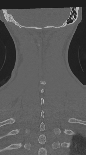 File:Cervical intercalary bone (Radiopaedia 35211-36748 Coronal bone window 65).png