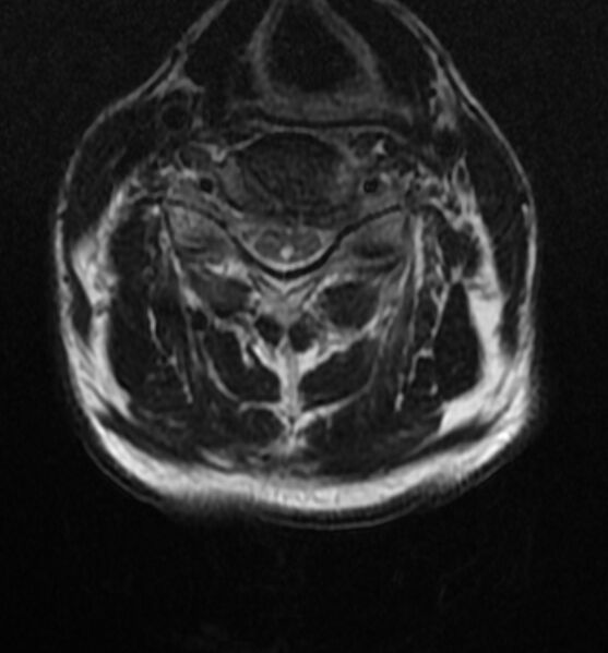 File:Cervical spondylodiscitis (Radiopaedia 81362-95110 Axial T2 9).jpg