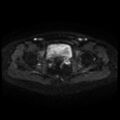 Cesarian section scar endometriosis (Radiopaedia 66520-75799 Axial DWI 44).jpg