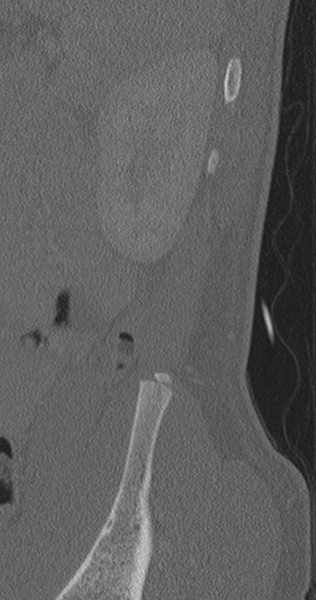 File:Chance fracture (Radiopaedia 40360-42912 Sagittal bone window 5).png