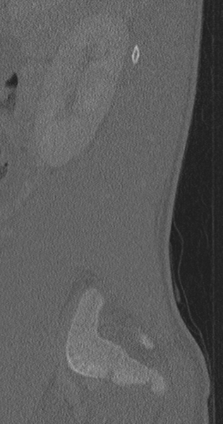File:Chance fracture (Radiopaedia 40360-42912 Sagittal bone window 81).png