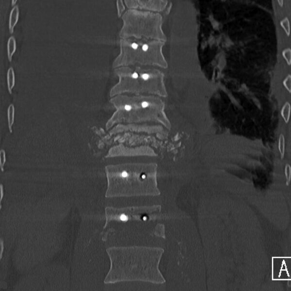 File:Charcot joint - spine (Radiopaedia 7198-8156 Coronal bone window 1).jpg