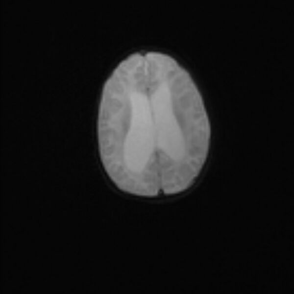 File:Chiari III malformation with occipital encephalocele (Radiopaedia 79446-92559 Axial DWI 16).jpg