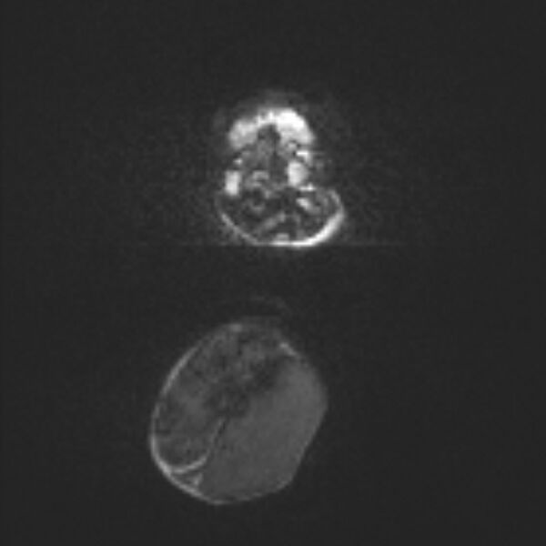 File:Chiari III malformation with occipital encephalocele (Radiopaedia 79446-92559 Axial DWI 25).jpg