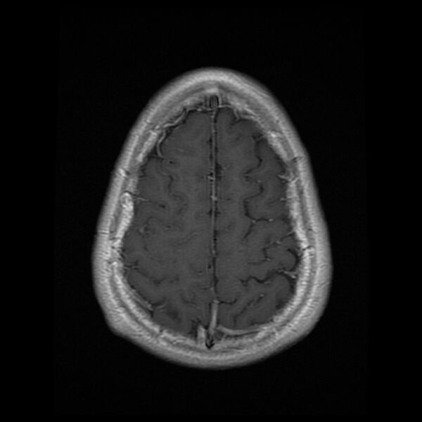 File:Chiasmatic-hypothalamic juvenile pilocytic astrocytoma (Radiopaedia 78533-91236 Axial T1 C+ 24).jpg