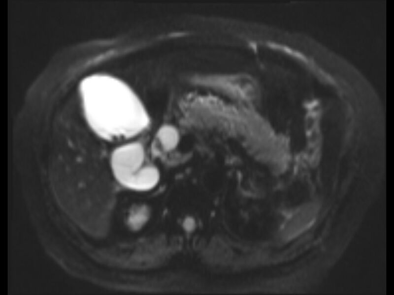 File:Choledocholithiasis causing intrahepatic biliary duct dilation (Radiopaedia 39908-42369 Axial T2 SPAIR 16).jpg