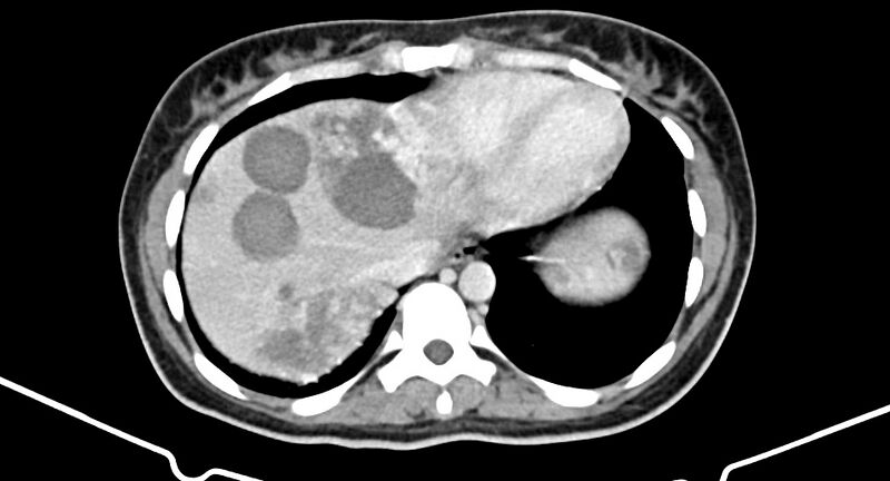 File:Choriocarcinoma liver metastases (Radiopaedia 74768-85766 A 27).jpg