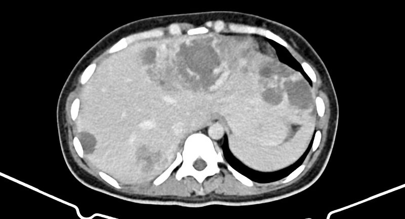 File:Choriocarcinoma liver metastases (Radiopaedia 74768-85766 A 40).jpg