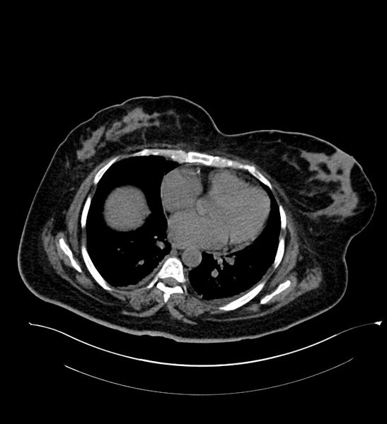 File:Chromophobe renal cell carcinoma (Radiopaedia 84239-99519 Axial non-contrast 13).jpg