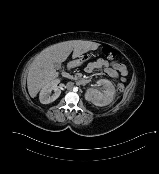 File:Chromophobe renal cell carcinoma (Radiopaedia 84239-99519 B 50).jpg