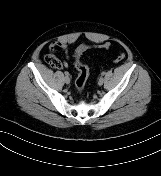 File:Chromophobe renal cell carcinoma (Radiopaedia 84286-99573 Axial non-contrast 51).jpg