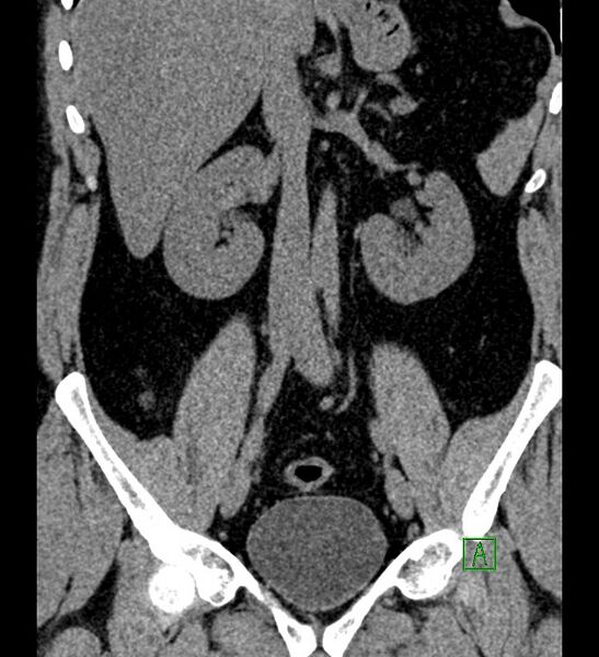 File:Chromophobe renal cell carcinoma (Radiopaedia 84286-99573 Coronal non-contrast 94).jpg