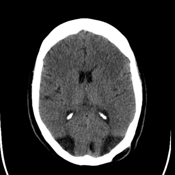 File:Chronic bilateral occipital lobe infarcts (Radiopaedia 31276-31996 Axial non-contrast 24).jpg