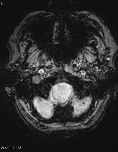 File:Chronic lymphocytic inflammation with pontine perivascular enhancement responsive to steroids (CLIPPERS) (Radiopaedia 37520-39374 Axial SWI 5).jpg